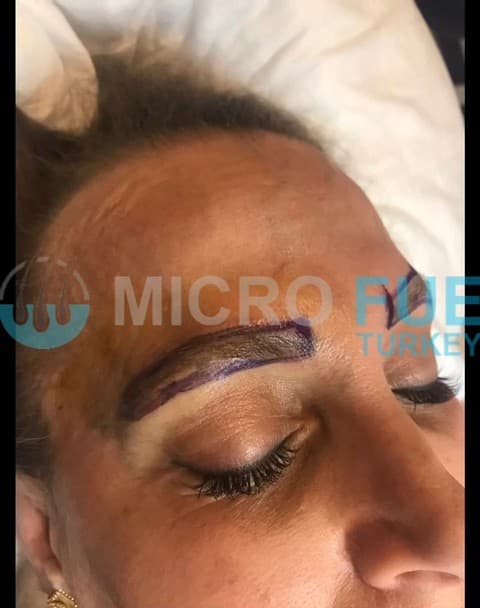 Planning an Eyebrow Transplant in Turkey