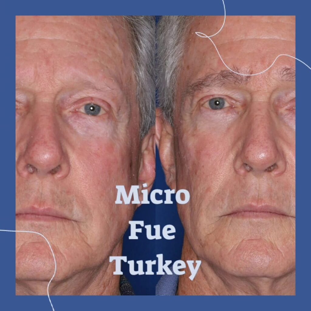 Turkey Eyebrow Transplant Cost