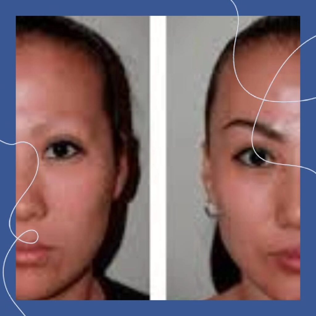 Eyebrow Transplant in K