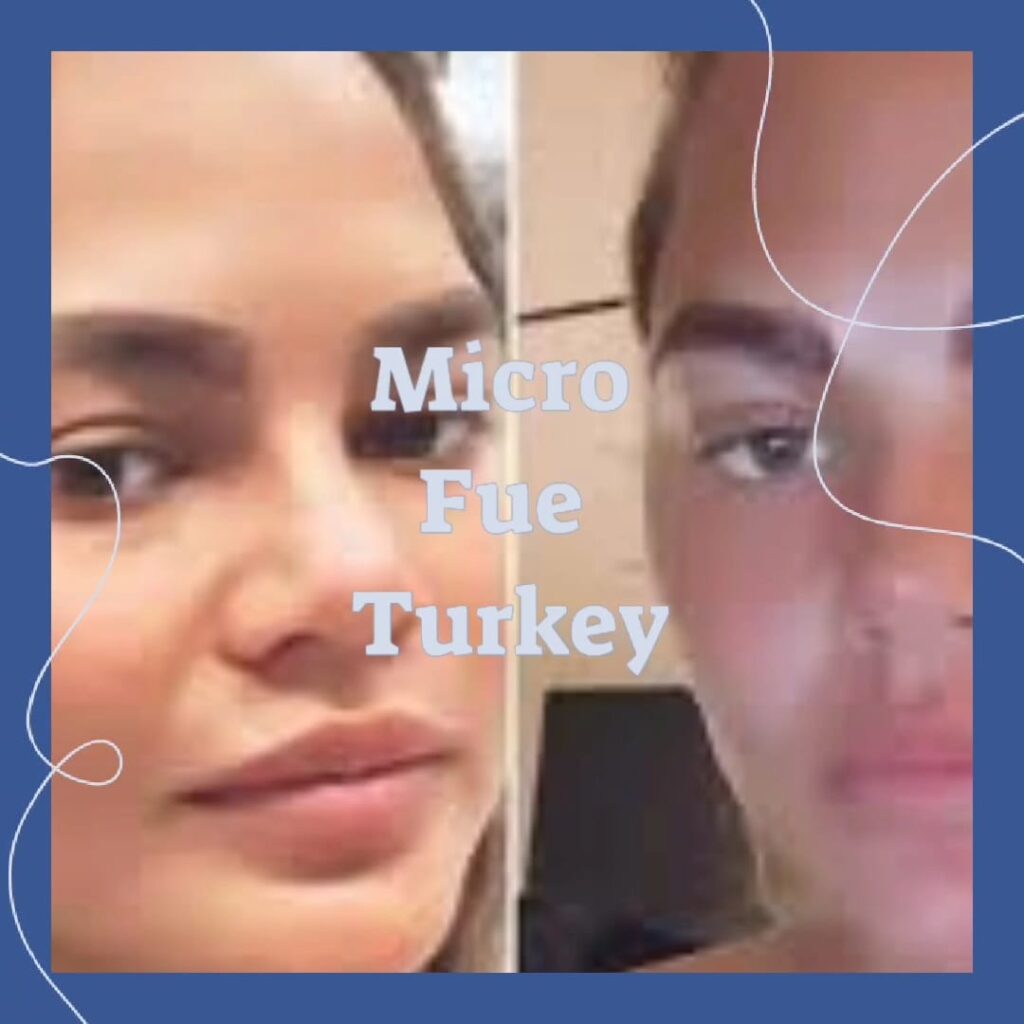Turkey Eyebrow Transplant Cost