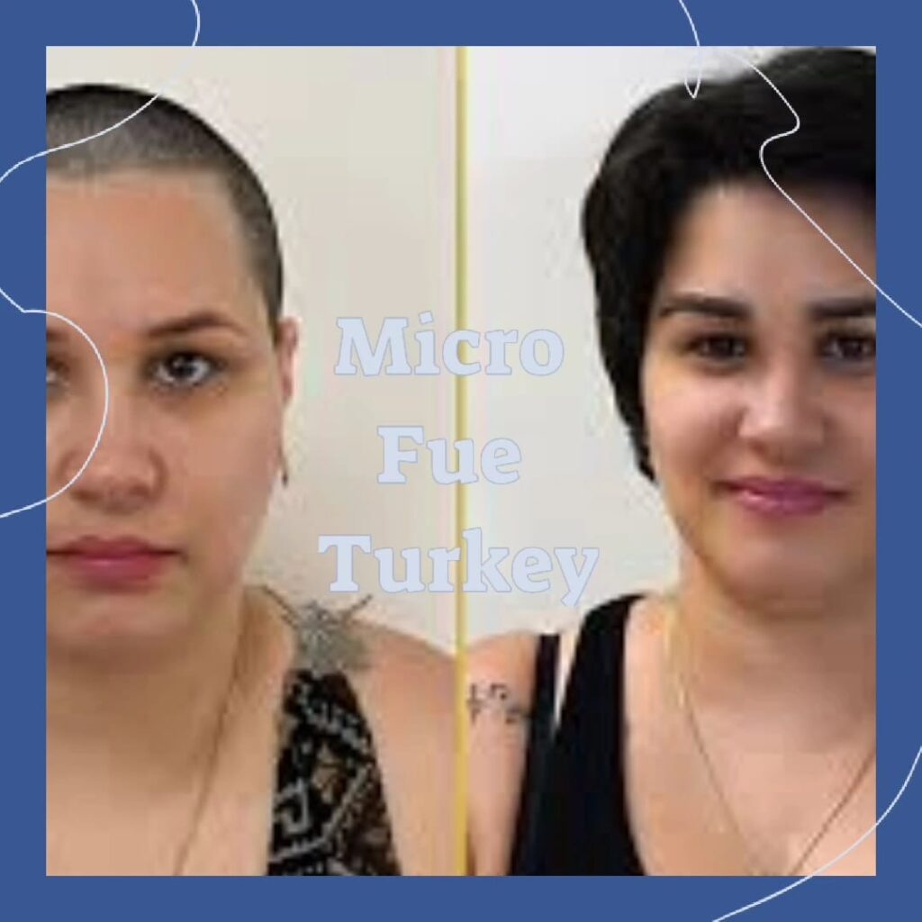 Eyebrow Transplant Istanbul