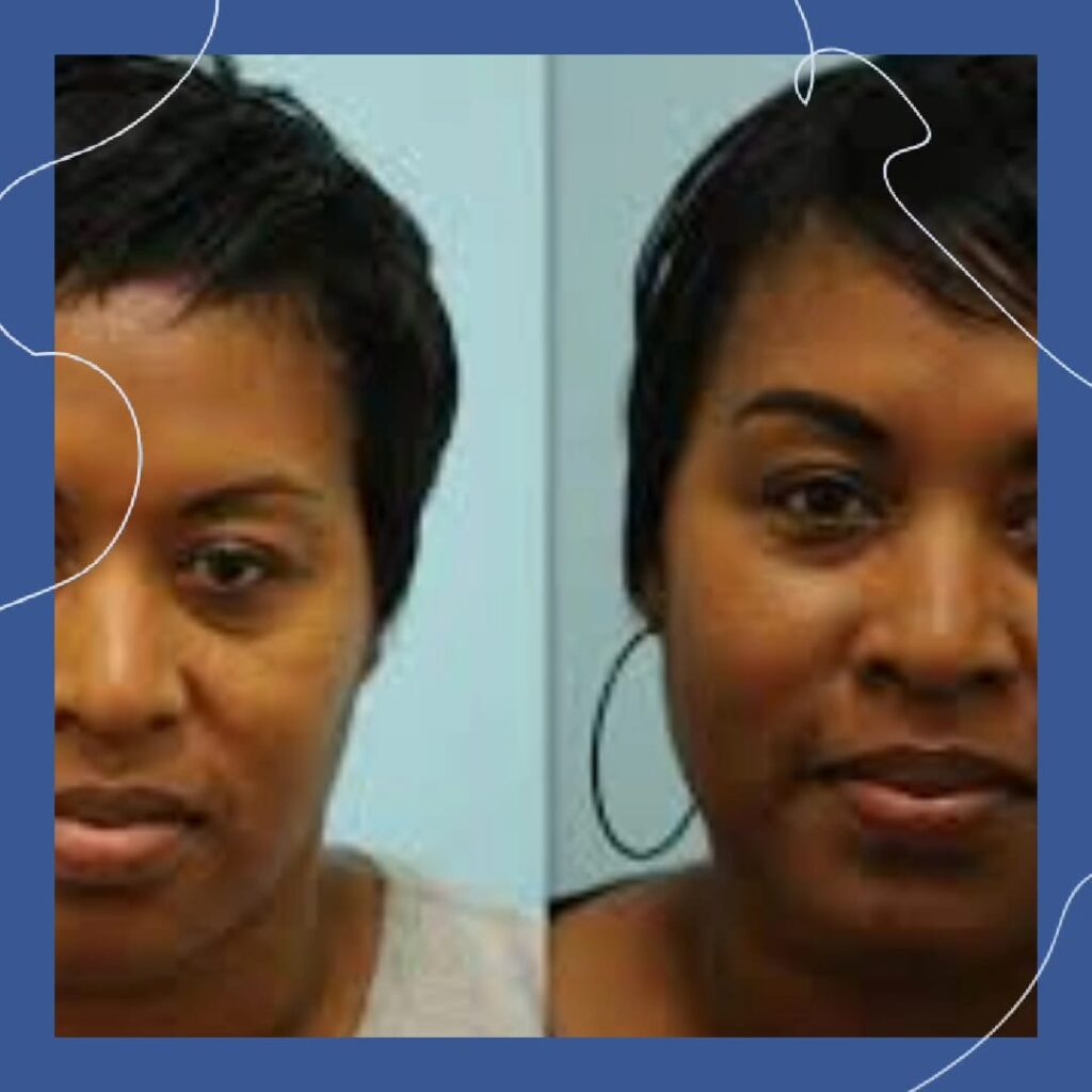 Eyebrow Transplant Istanbul