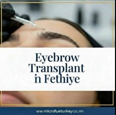 Eyebrow Transplant in Fethiye